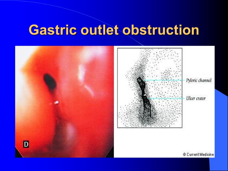 Gastric outlet obstruction